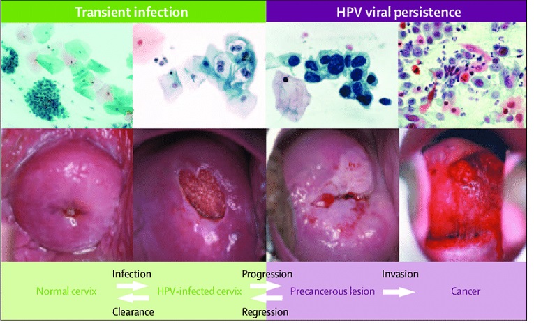 سرطان ناشی از ویروس HPV